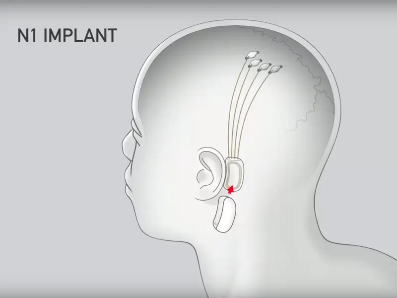 The Future is Here: Neural ink, Led by Elon Musk, Pioneers Brain Chip Implantation in Humans"